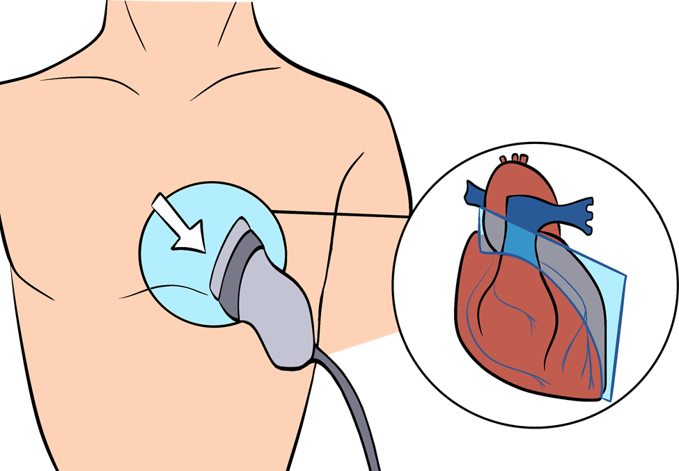 Parasternal long-axis view of the heart.