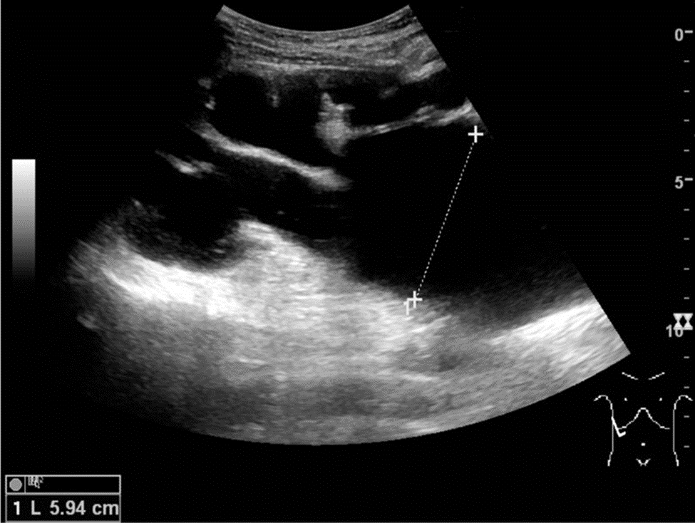 Ultrasonography of end-stage hydronephrosis.