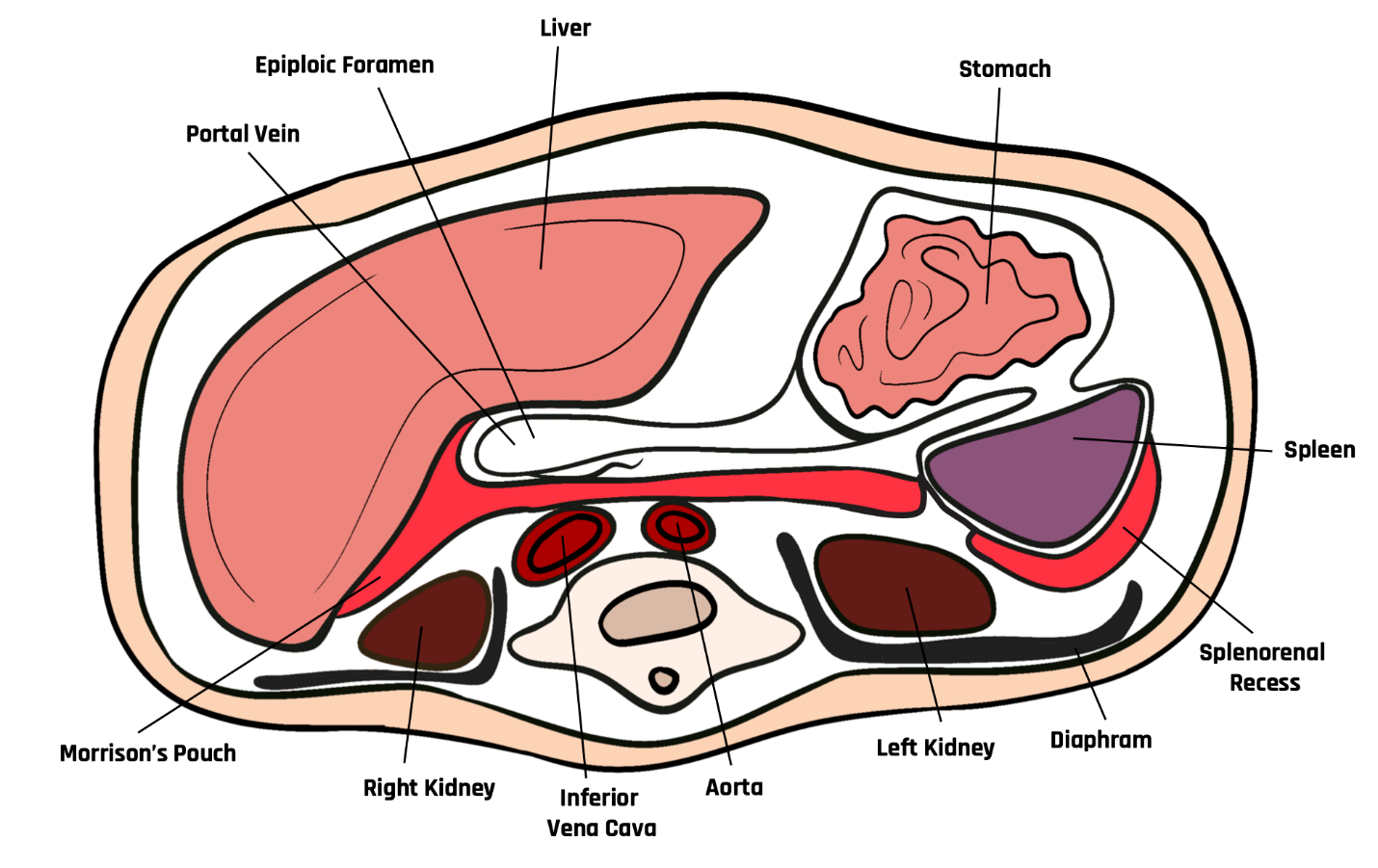 Cross-sectional diagram demonstrating Morrison’s pouch (hepatorenal) and the splenorenal recess.