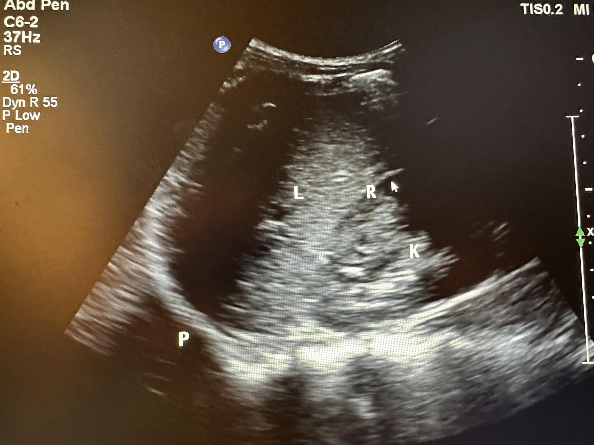 Hepatorenal view illustrating liver, hepatorenal recess (with the arrow pointing), kidney, and pleura.