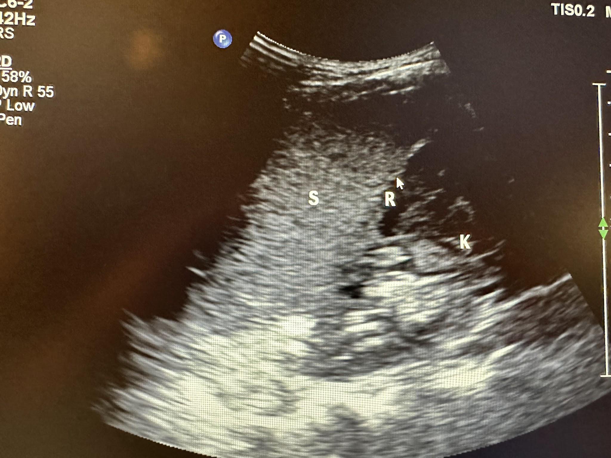 Splenorenal view illustrating spleen, splenorenal recess (with the arrow pointing), and the kidney.