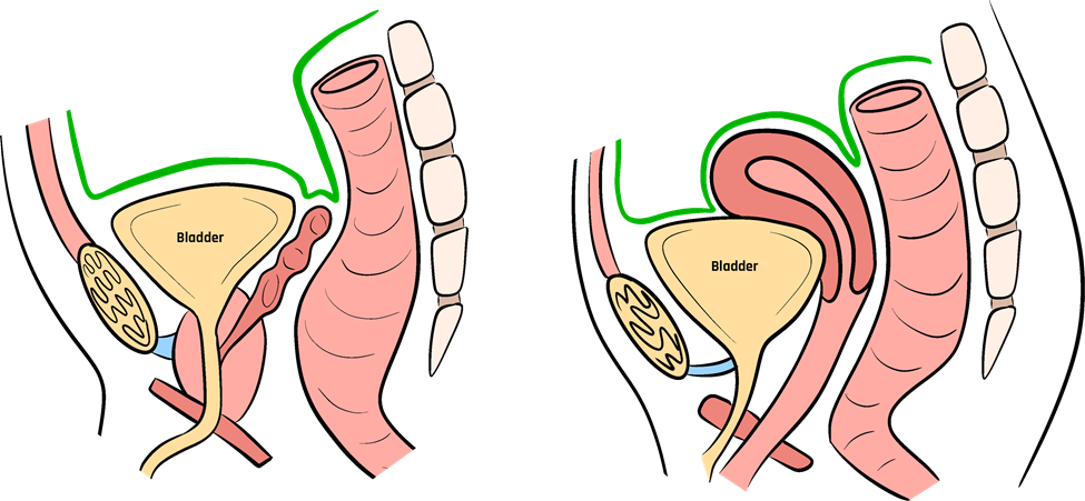 Pouches (recess) in the male and female.