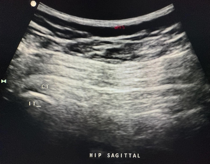 Sagittal hip image of the conjoined tendons (CT) of the biceps femoris and semitendinosus into the ischial tuberosity (IT). The abbreviations given here and labeled on the ultrasound image represent the corresponding structures.