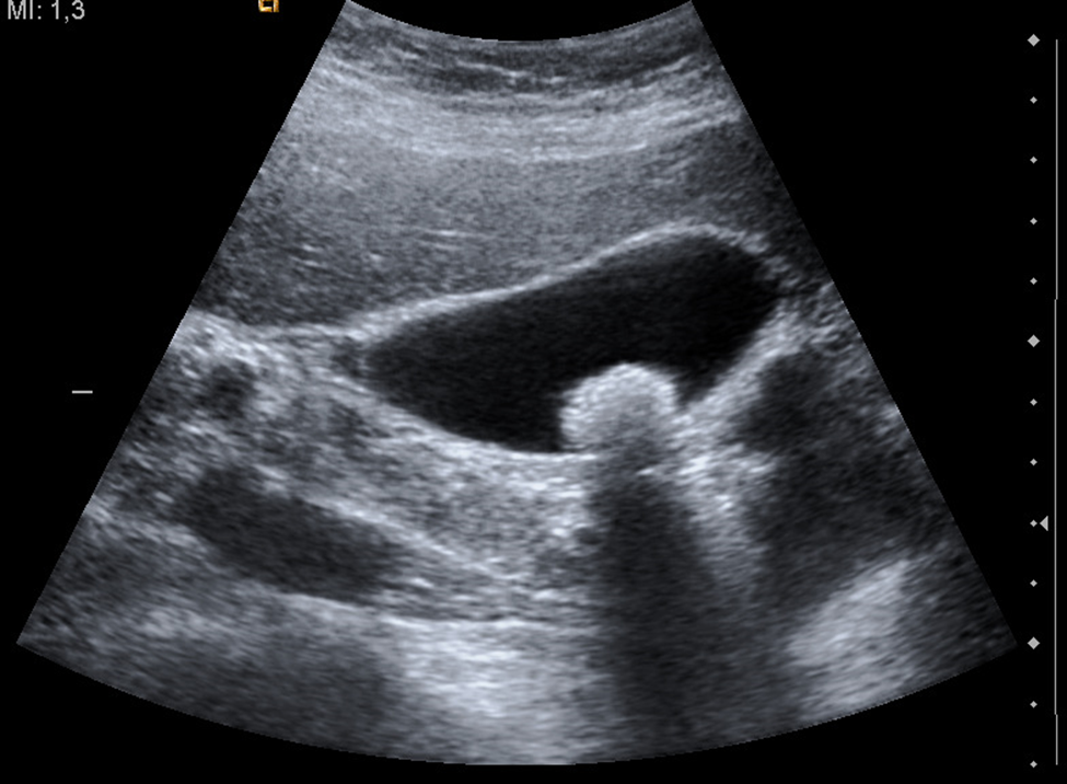 Ultrasound image of gallbladder stone.