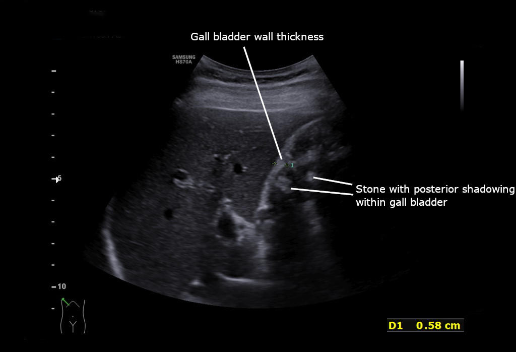 Acute cholecystitis as seen on the ultrasound axial view.