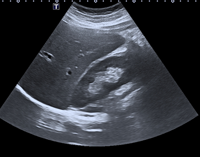 Abdominal ultrasound showing the right lobe of the liver and right kidney.