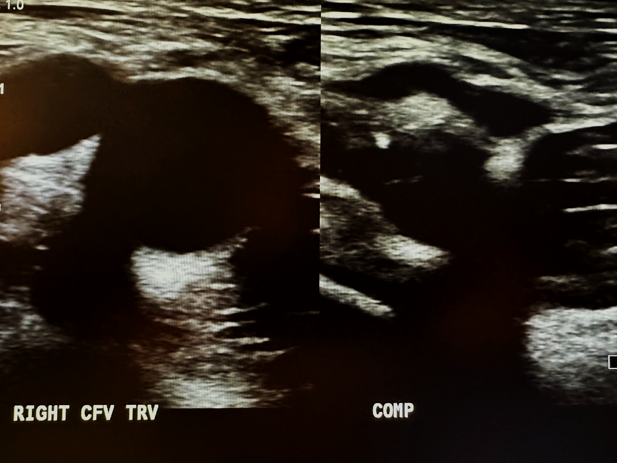 Side-by-side transverse ultrasound views of the right common femoral vein without compression and with compression.