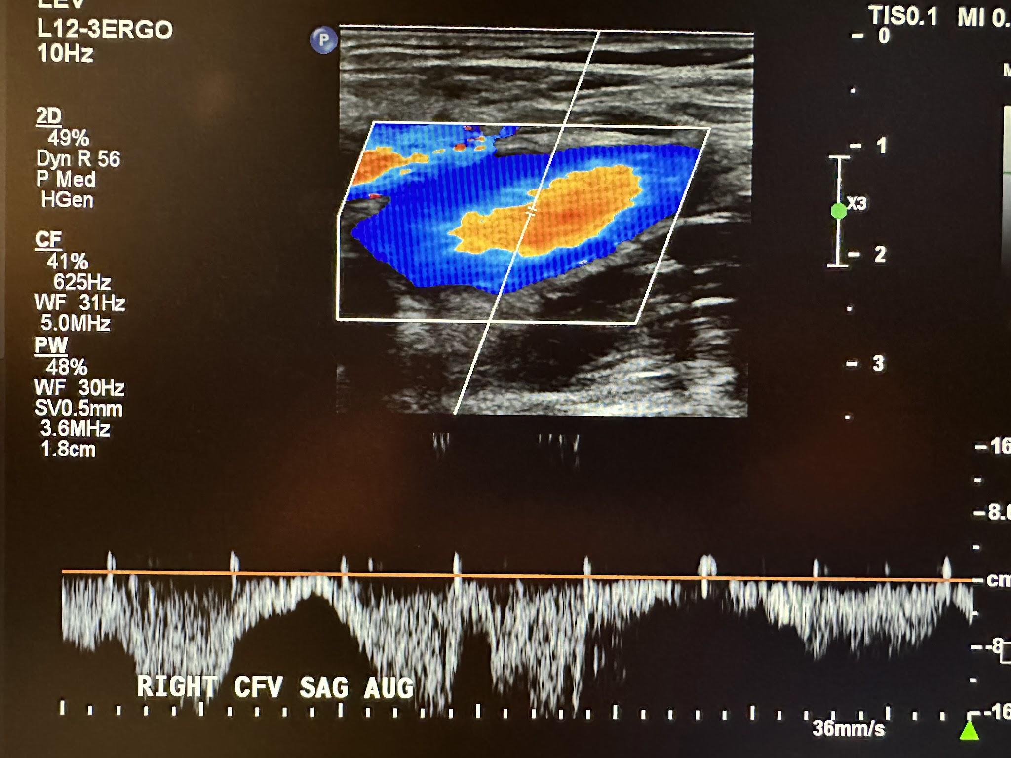 Right common femoral vein sagittal view with augmentation.