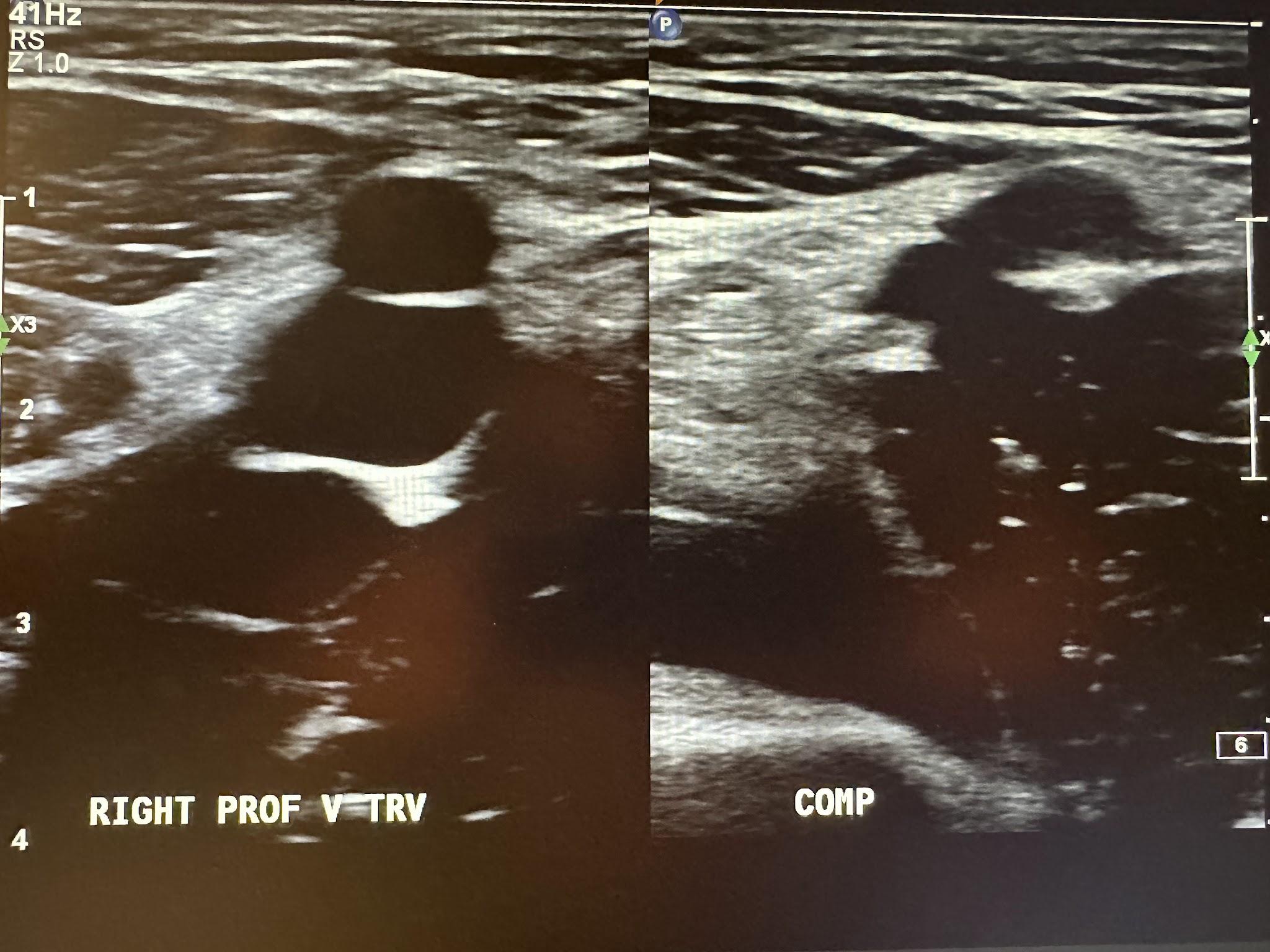 Side-by-side transverse image of the right profunda femoral vein without and with compression.