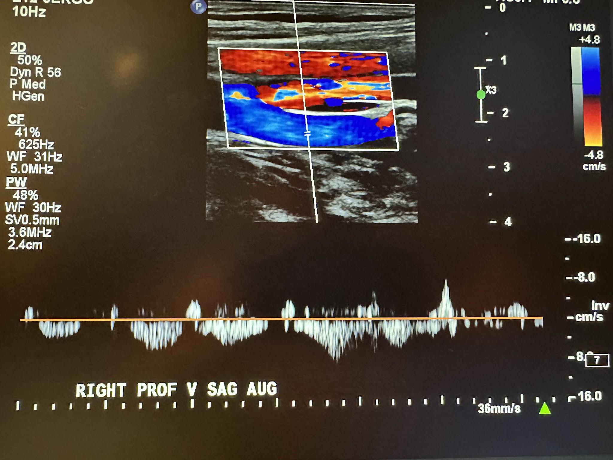 Right profunda femoral vein sagittal view with augmentation.