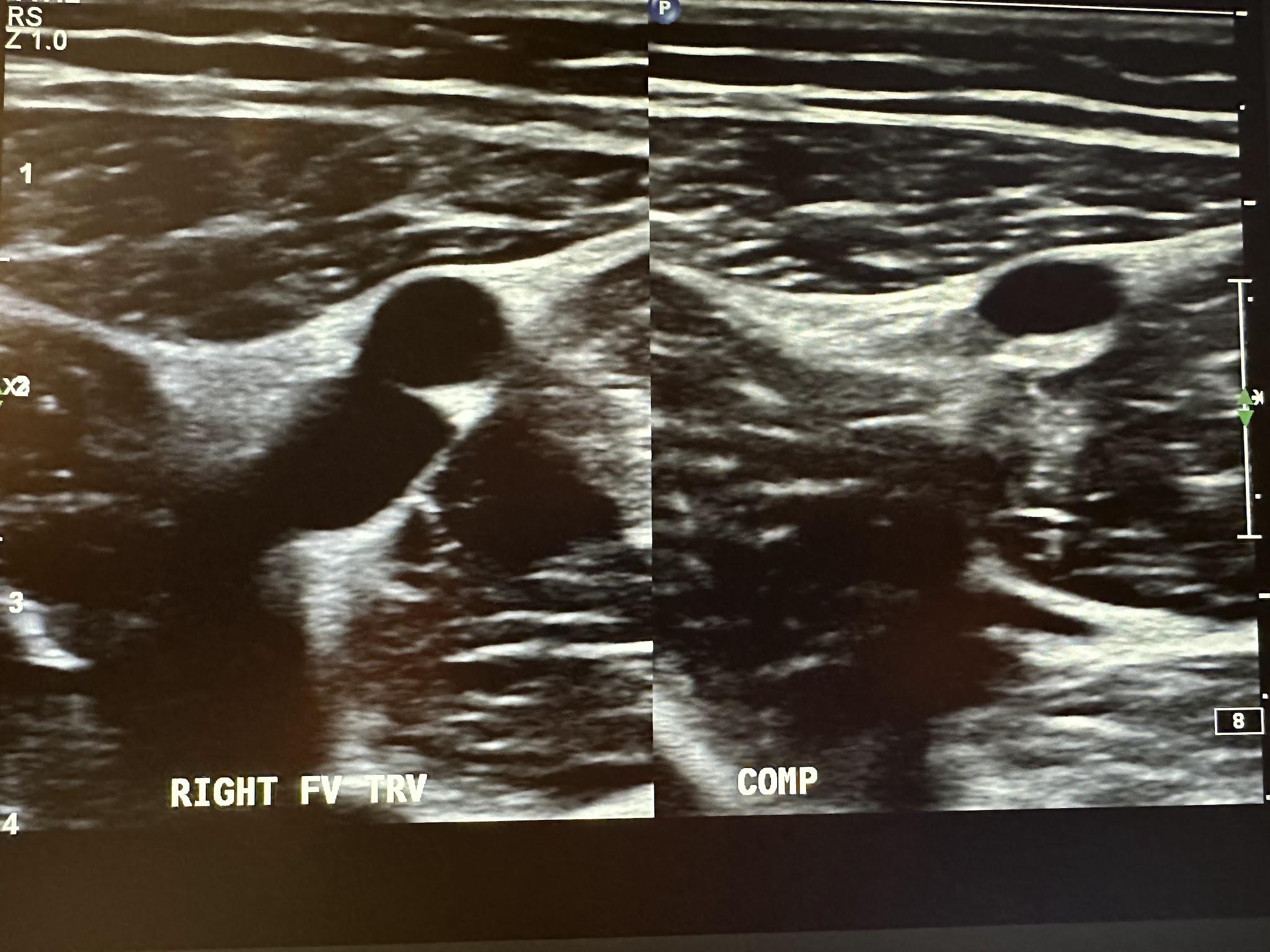 Side-by-side right femoral vein transverse view without and with compression.