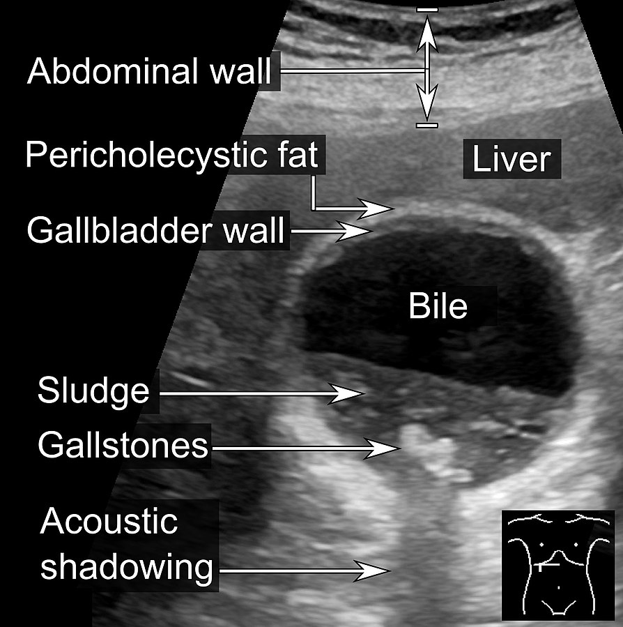 The stones in gallbladders are very bright, and they cast an acoustic shadow posterior to the stones.