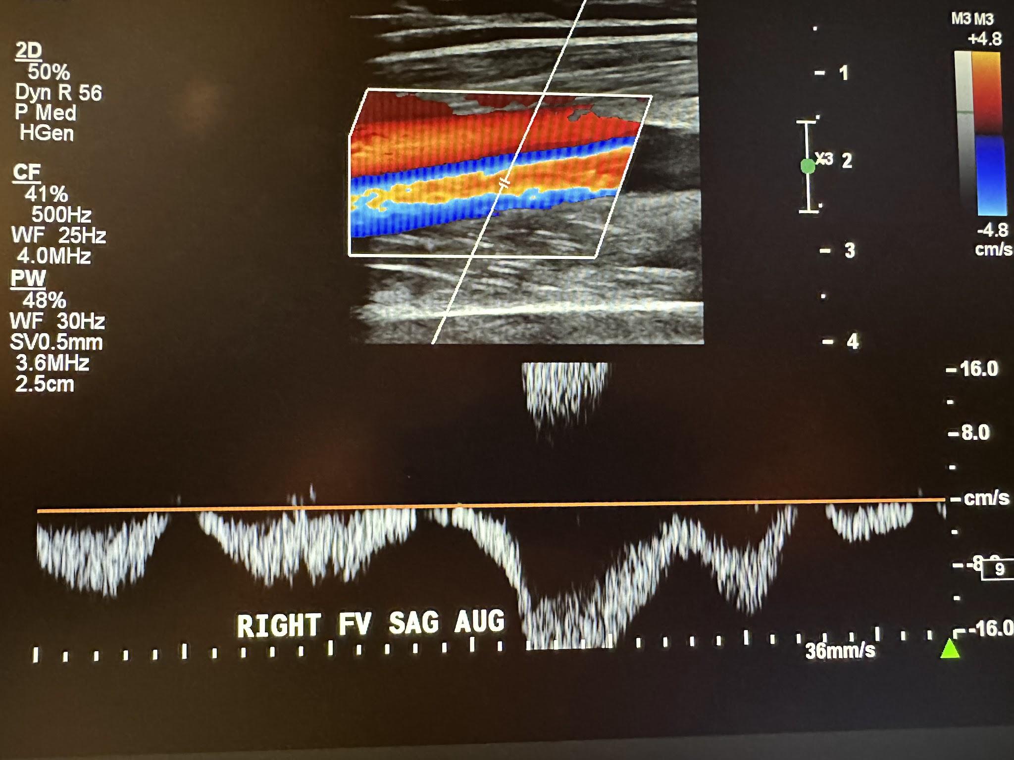 Right femoral vein sagittal view with augmentation.