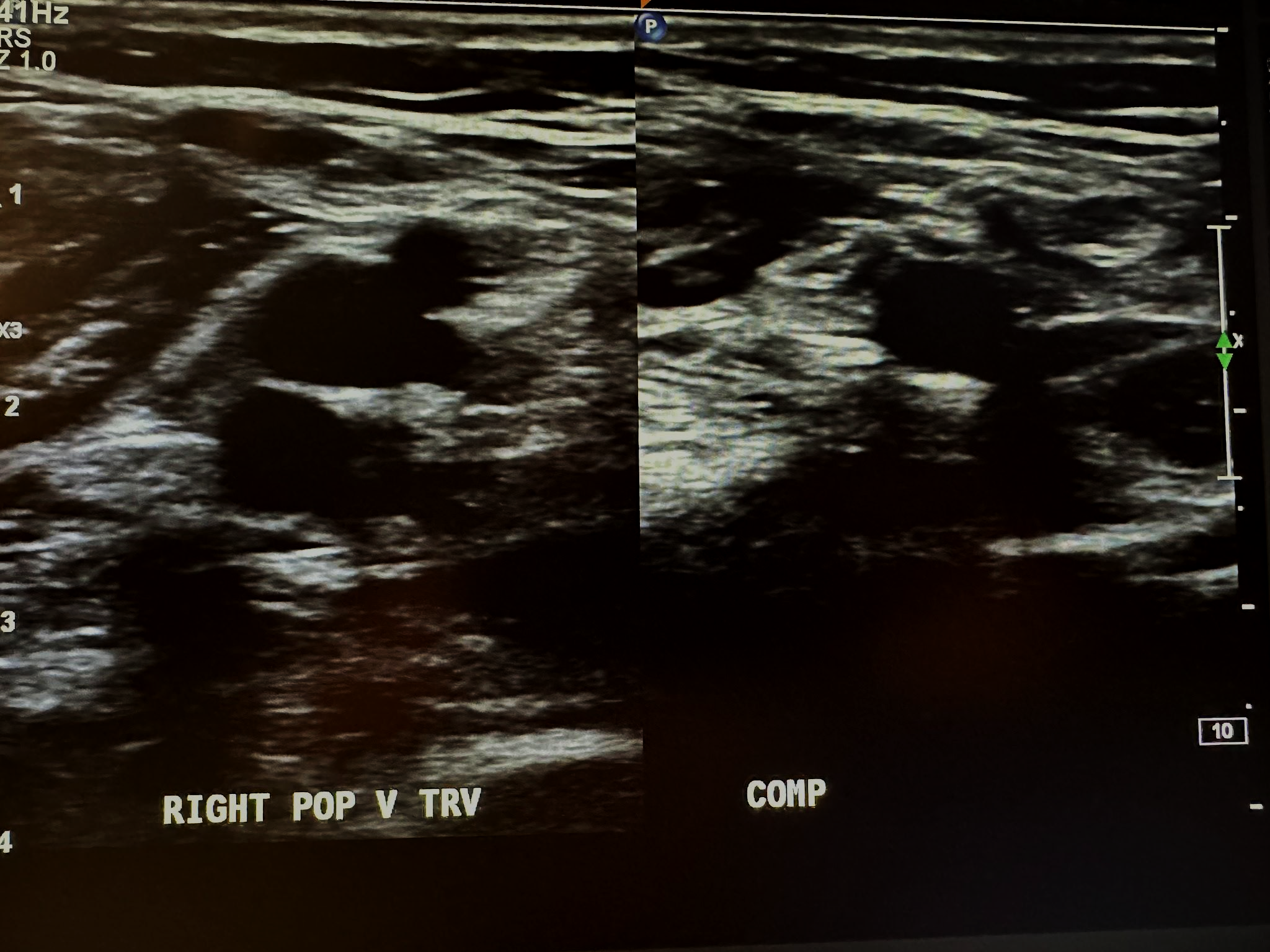 Side-by-side right popliteal vein transverse view without and with compression.