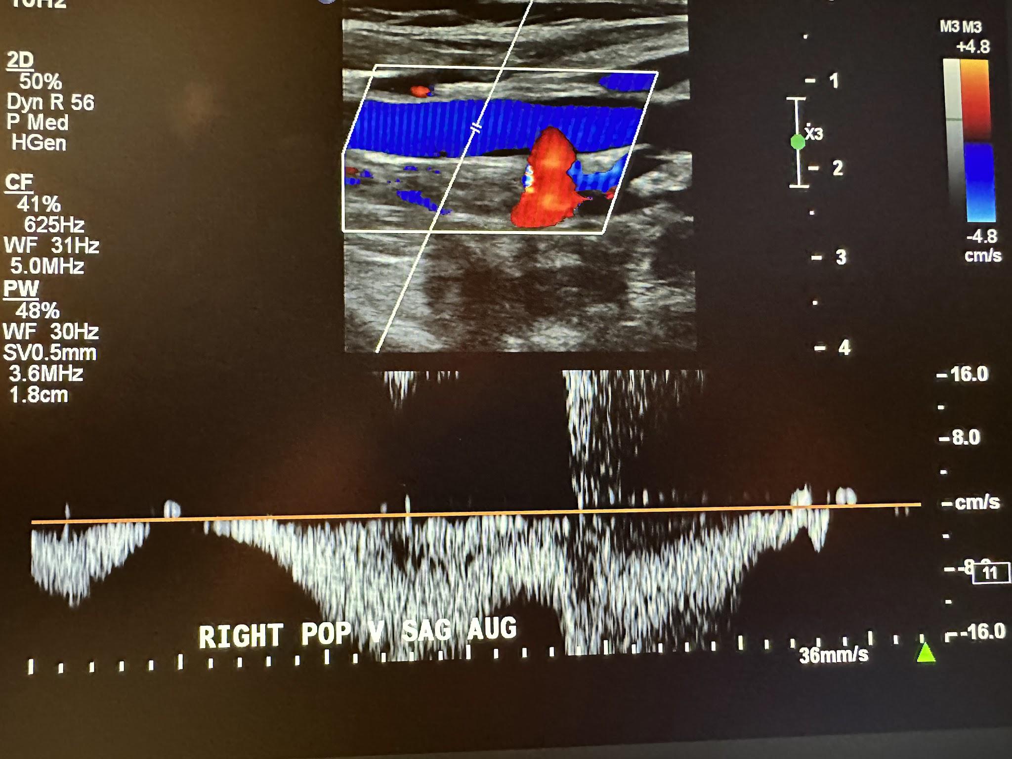 Right popliteal vein sagittal view with augmentation.