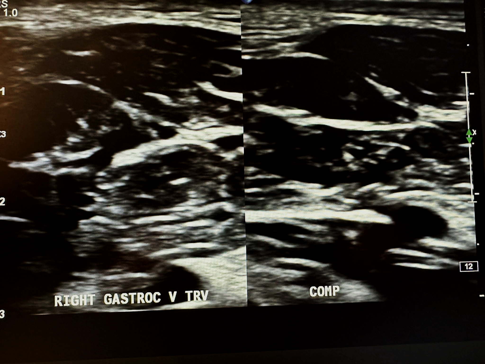 Side-by-side right gastrocnemius vein transverse view without and with compression.