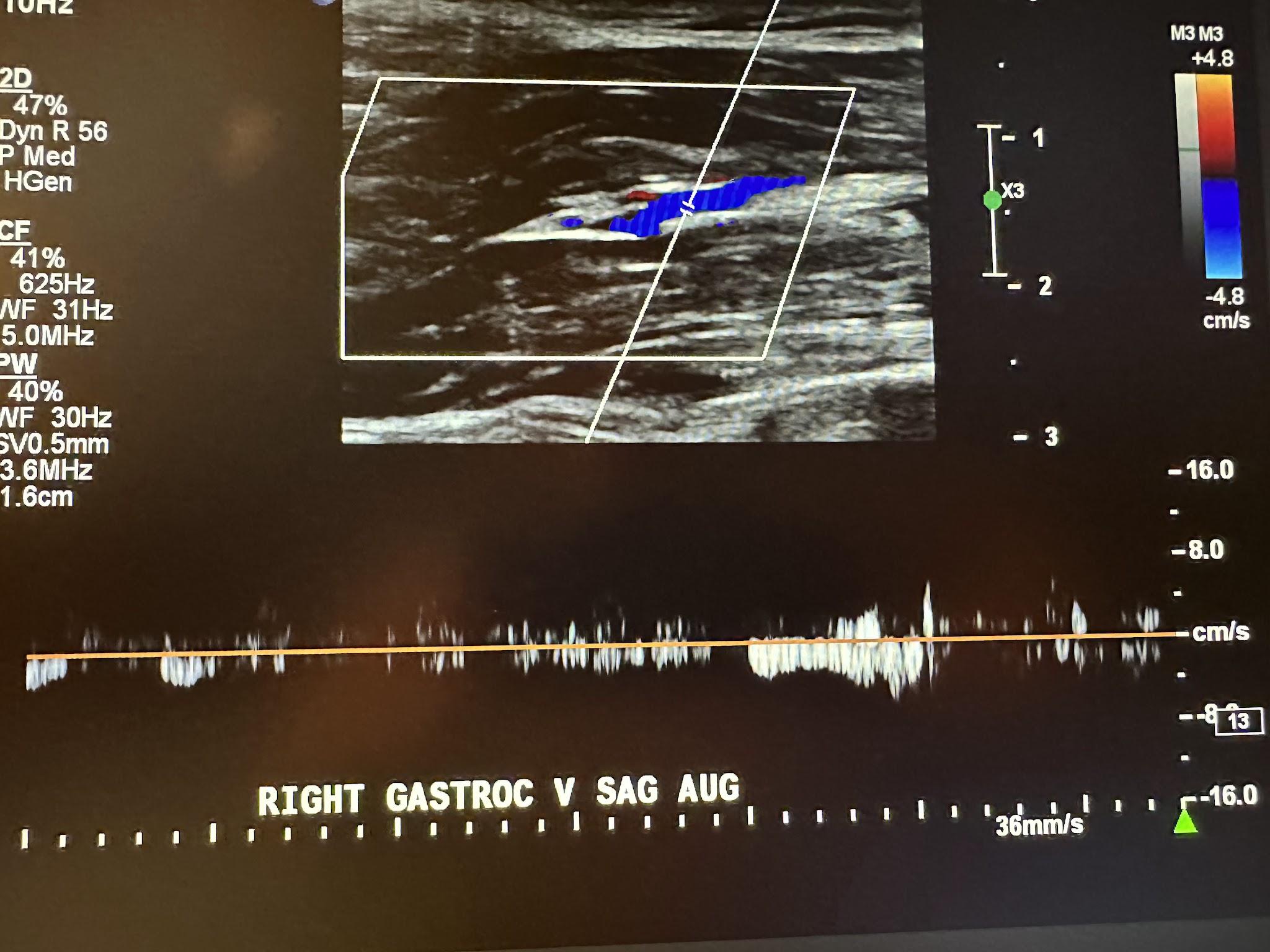 Right gastrocnemius vein sagittal view with augmentation.