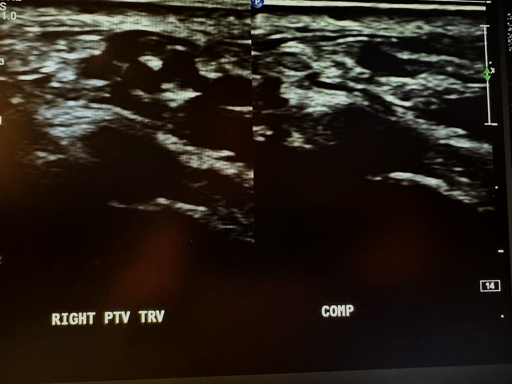 Side-by-side right posterior tibial veins transverse view without and with compression.