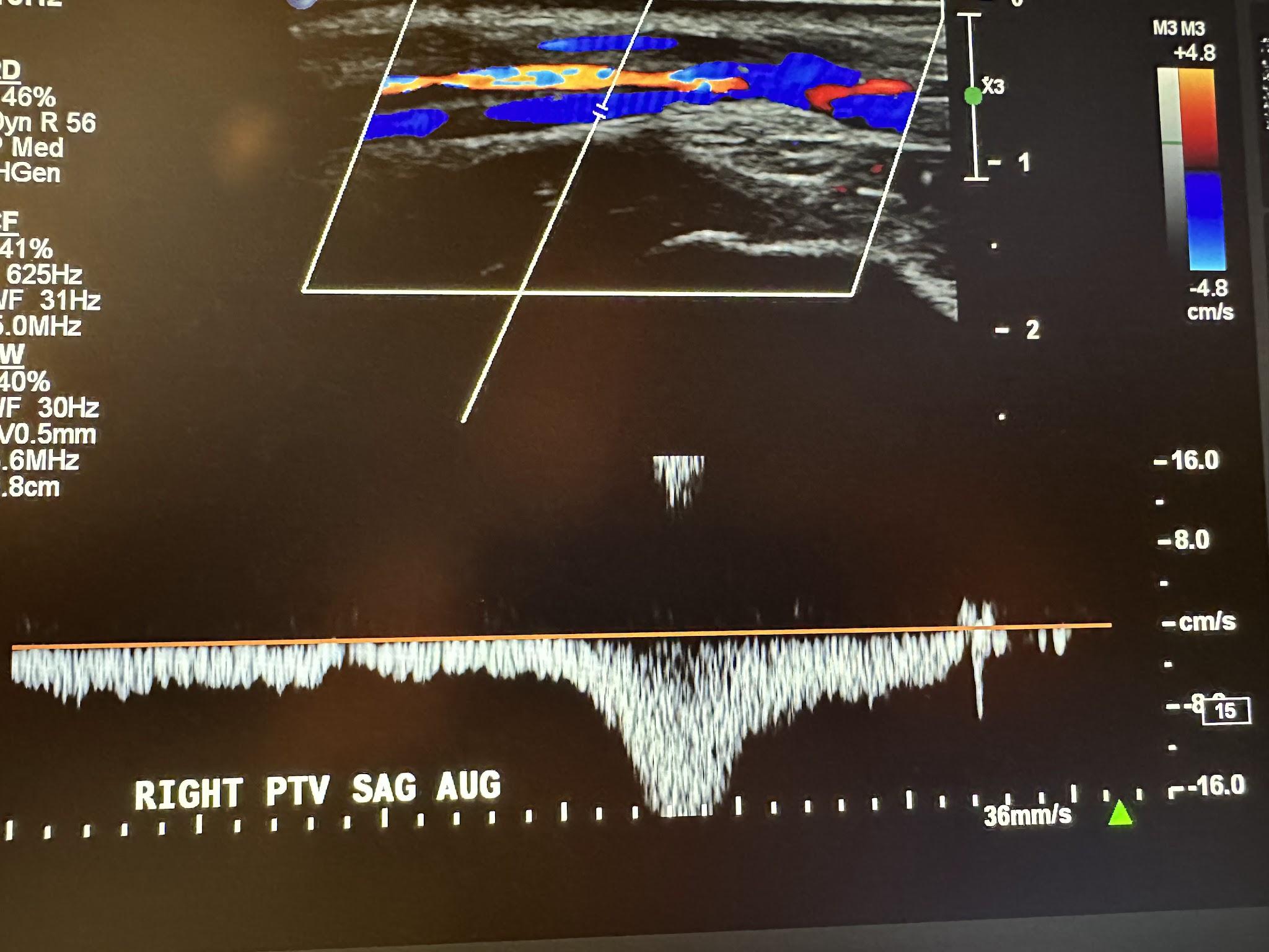 Right posterior tibial veins sagittal view with augmentation.