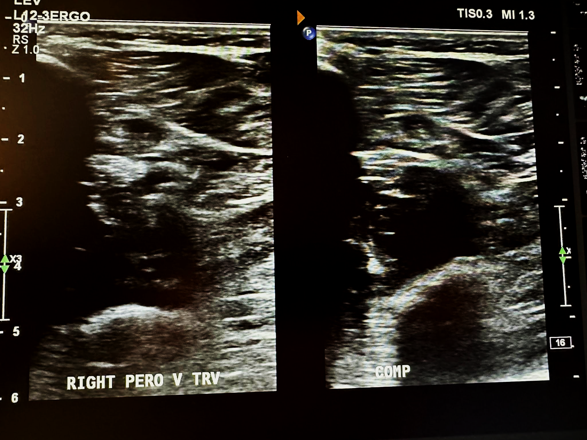 Side-by-side right peroneal veins transverse view without and with compression.