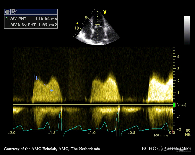 Echocardiogram showing severe mitral valve stenosis.