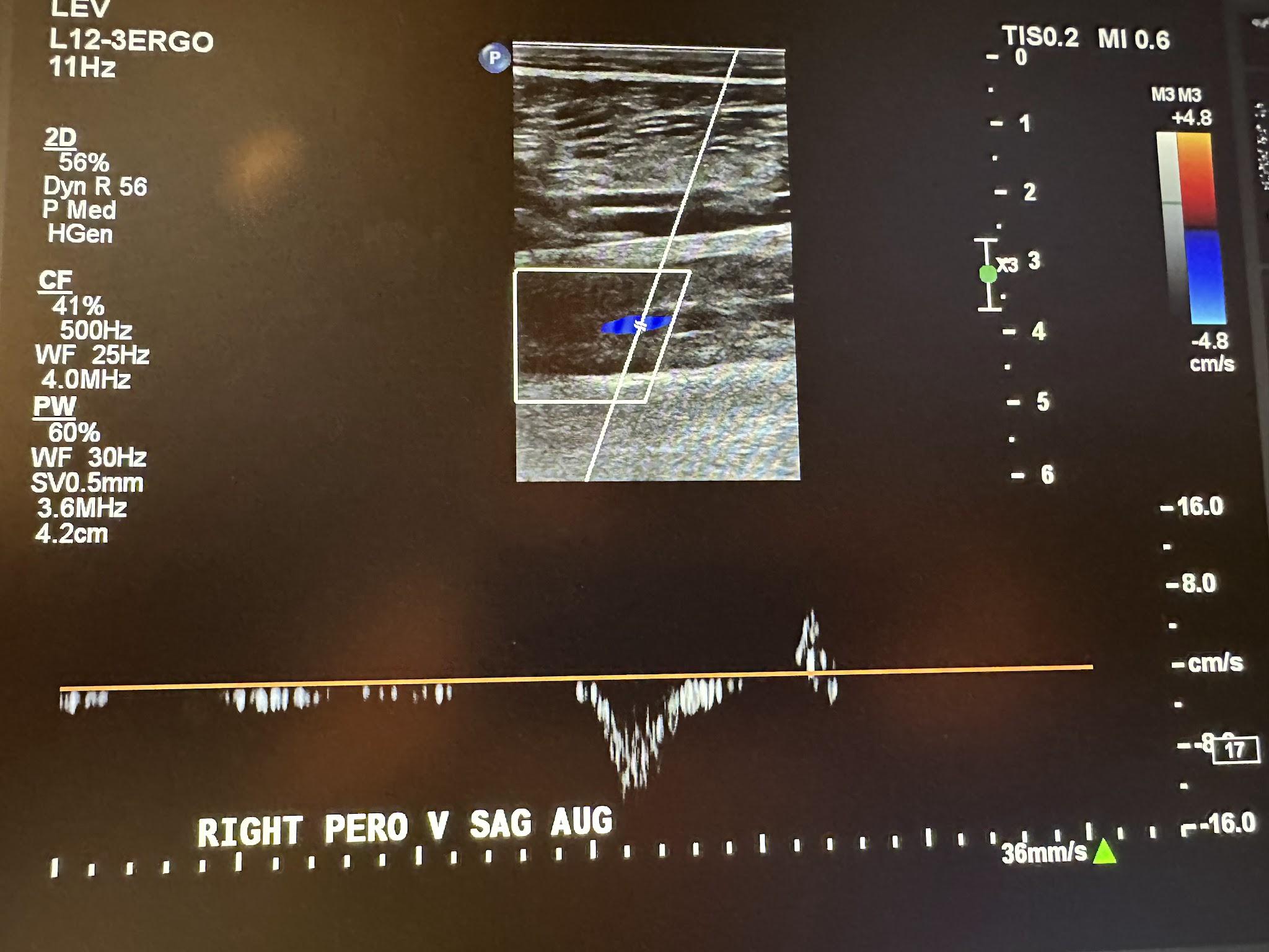 Right peroneal vein sagittal view with augmentation.