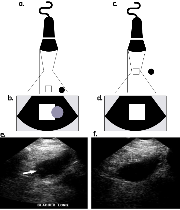 Beam width artifact can cause an image to appear in the wrong location due to side echoes that are erroneously interpreted by the machine as part of the central beam.