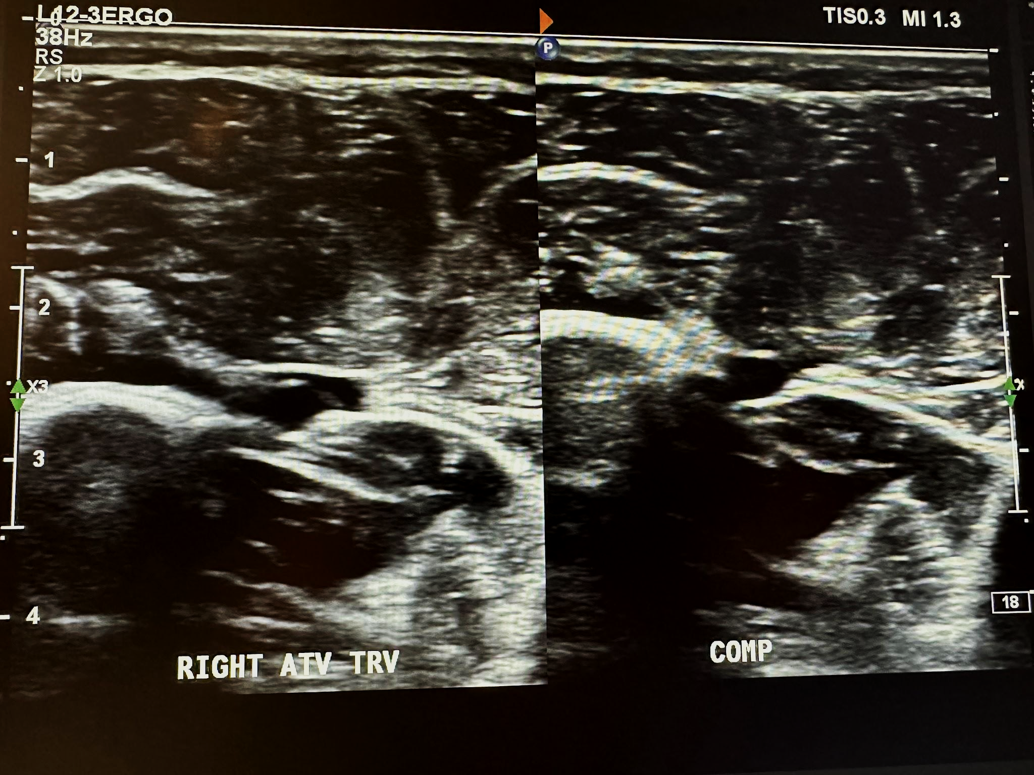 Side-by-side right anterior tibial vein transverse view without and with compression.