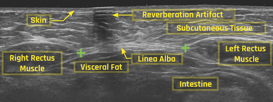 Reverberation artifacts are characterized as multiple horizontal lines that are equidistant from one another, and they are more pronounced as the intensity decreases with the depth.