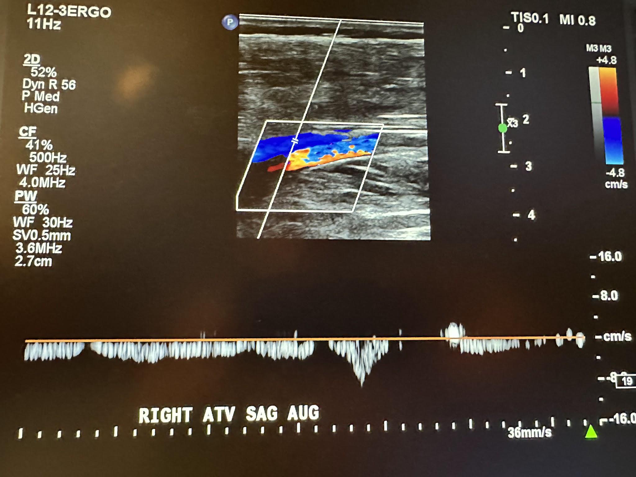 Right anterior tibial vein sagittal view with augmentation.