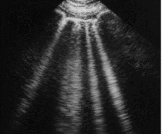 Comet tail artifact seen in the intercostal space.