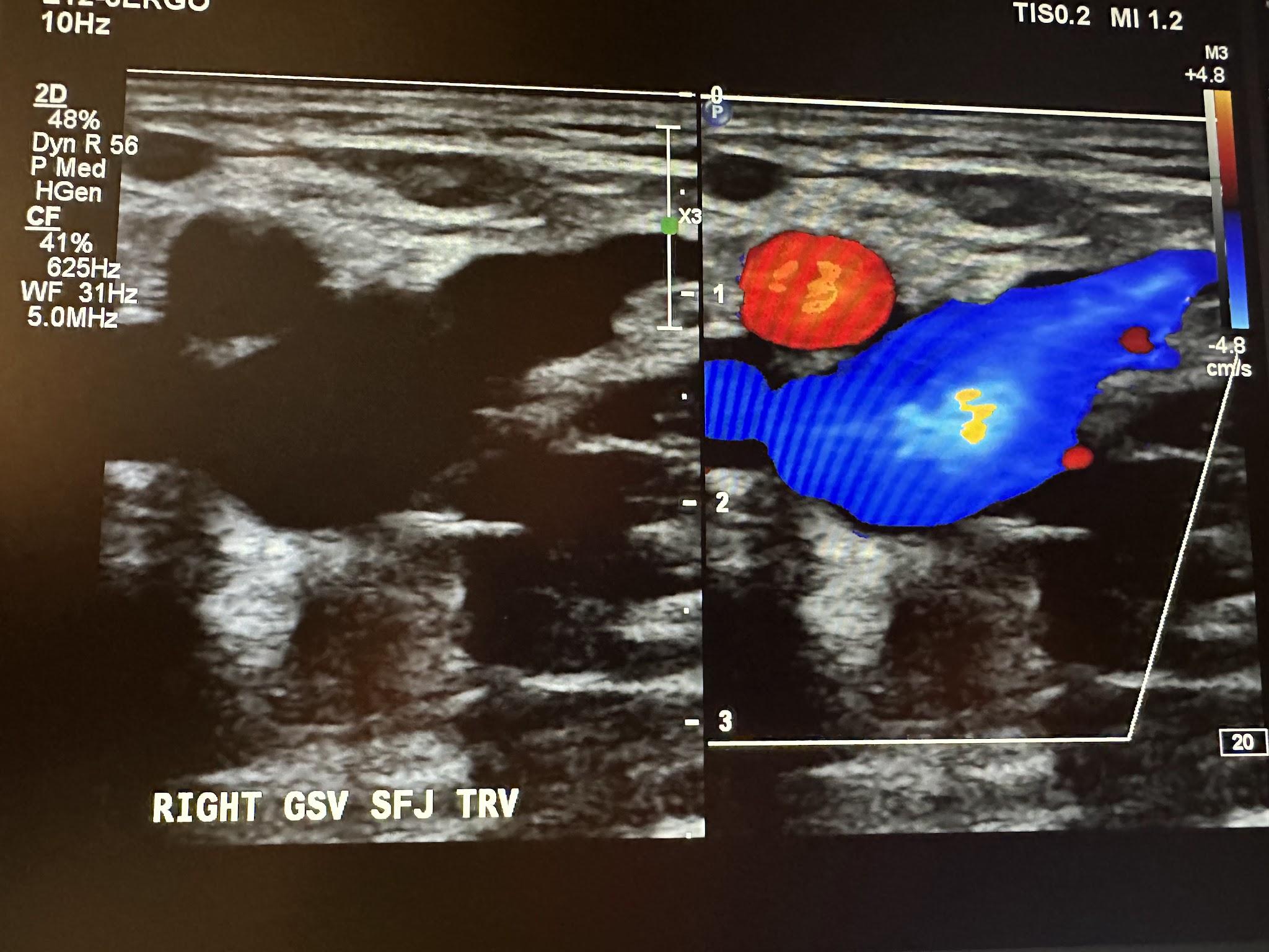 Side-by-side right great saphenous vein at the saphenofemoral junction transverse view without and with color Doppler.