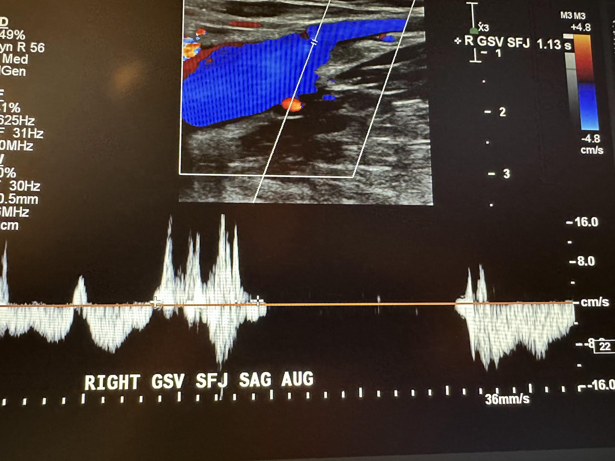 Right great saphenous vein at the saphenofemoral junction sagittal view with augmentation.