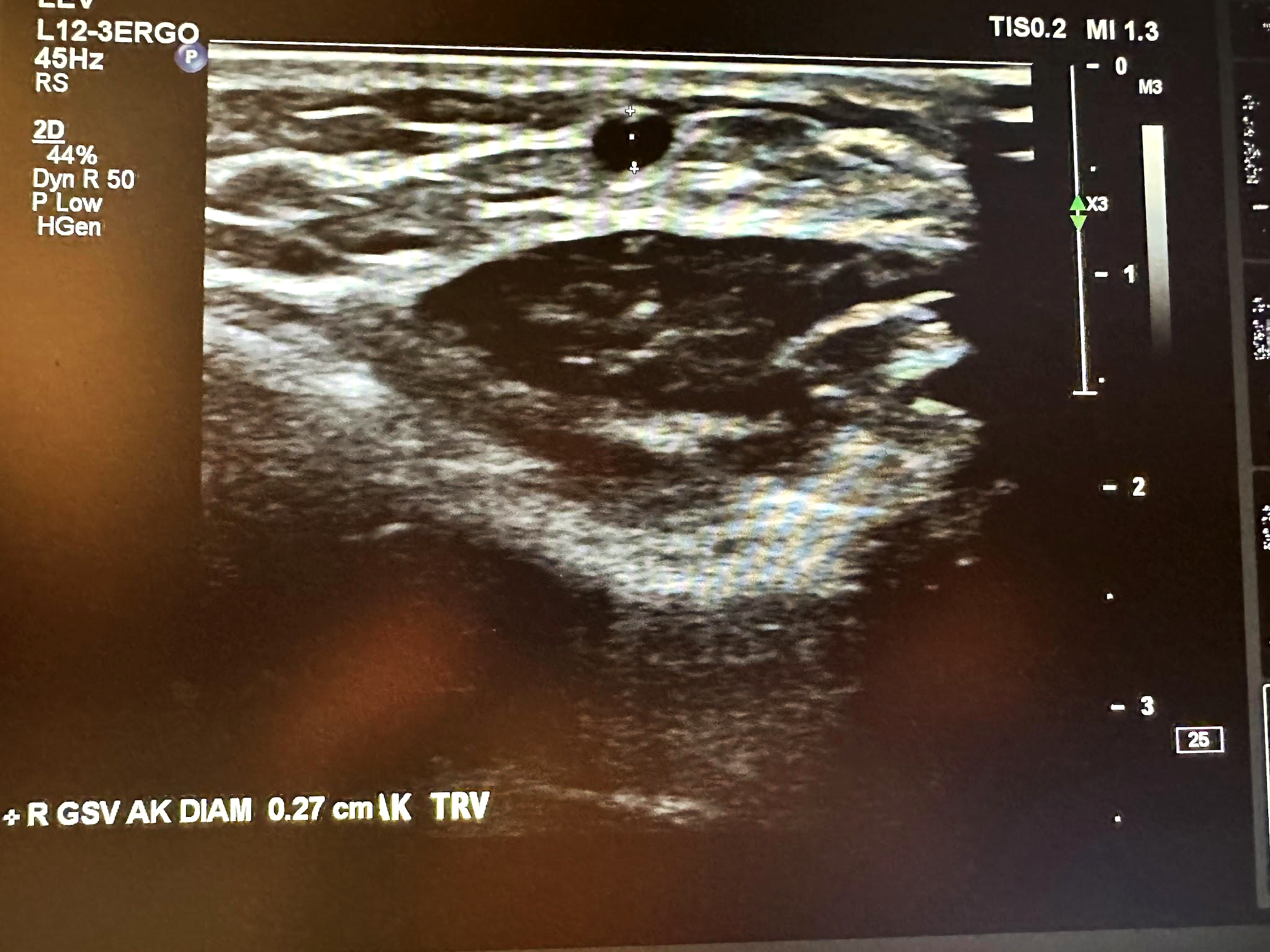 Right great saphenous vein transverse view above the knee.