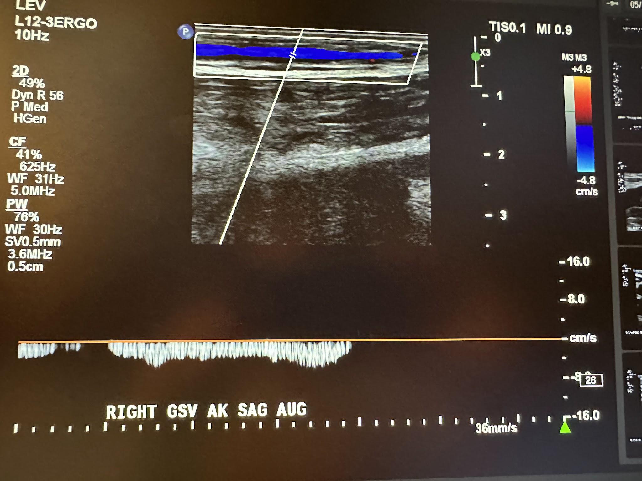 Right great saphenous vein above the knee sagittal view with augmentation.