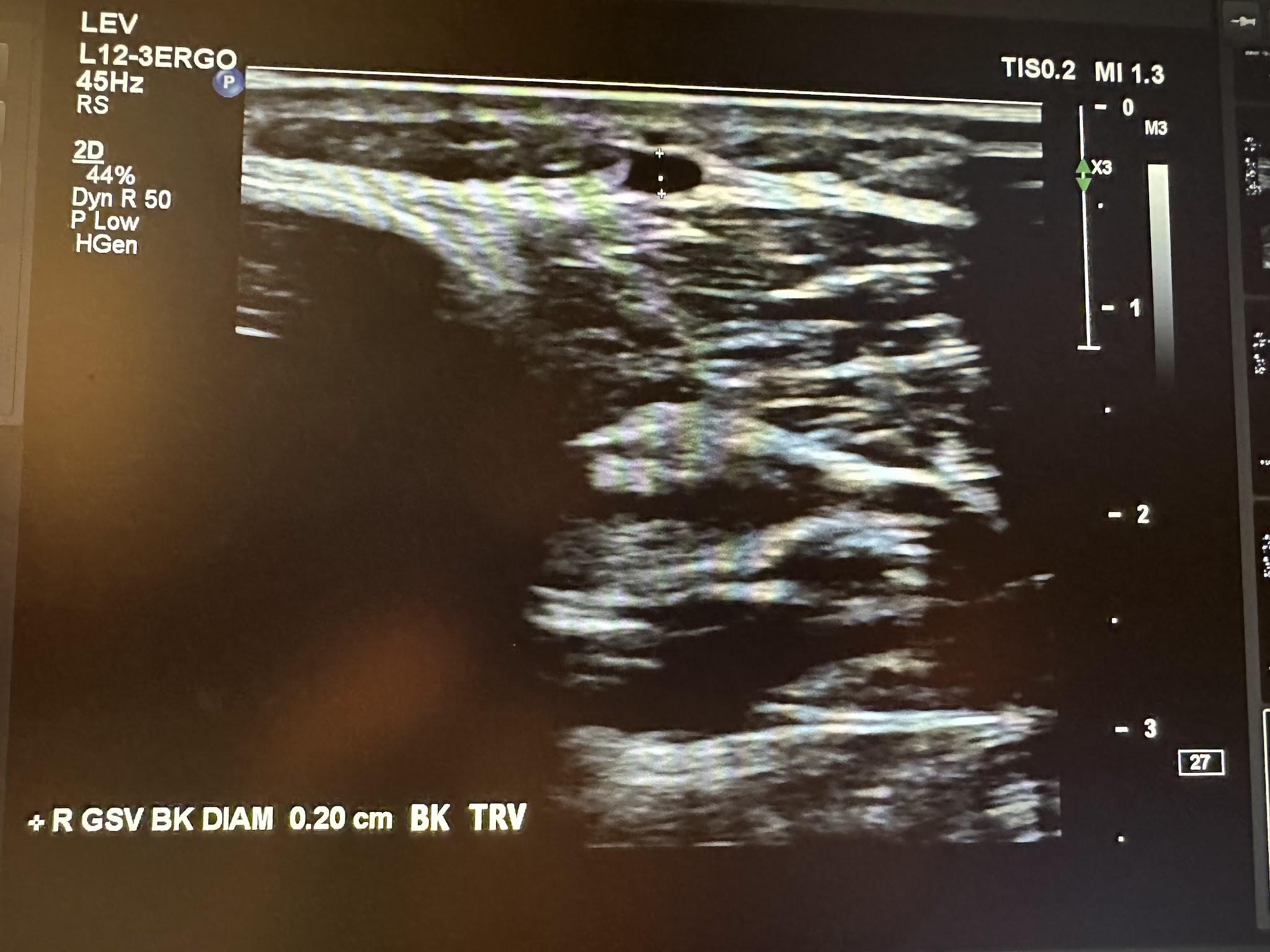 Right great saphenous vein below the knee transverse view.