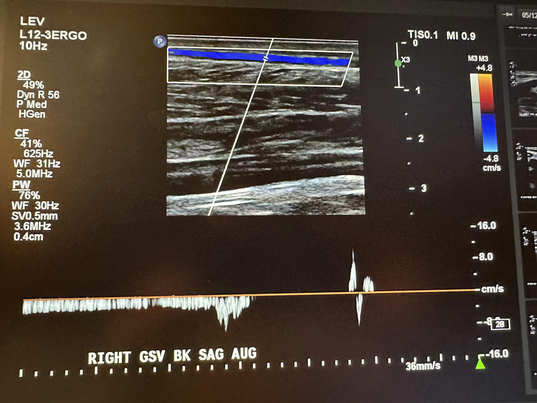 Right great saphenous vein below the knee sagittal view with augmentation.