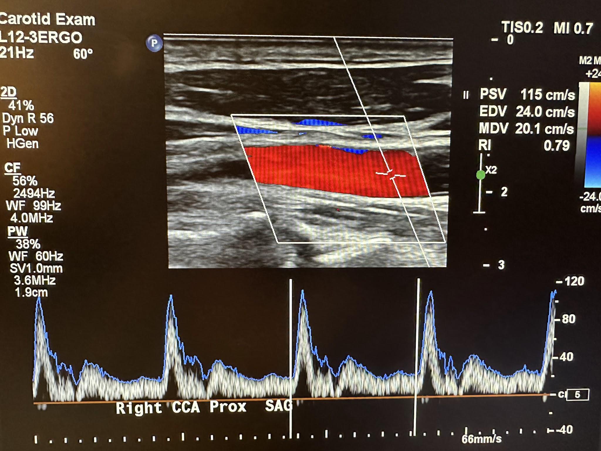 Ultrasound image of the right common carotid artery and the corresponding Doppler waveform.