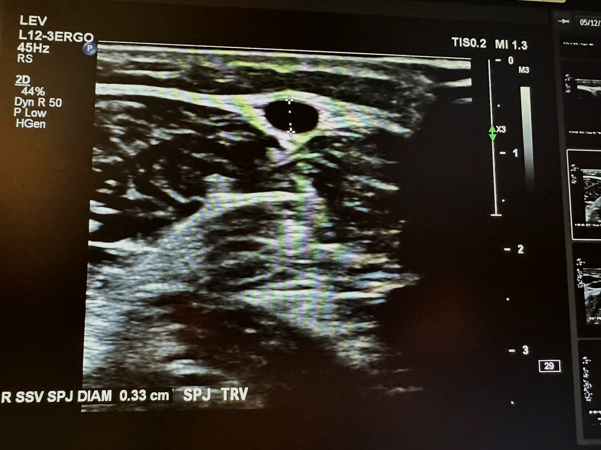 Right small saphenous vein at the saphenopopliteal junction transverse view.