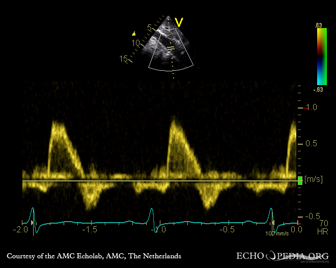 Echocardiogram showing dilated ascending aorta with severe aortic regurgitation.