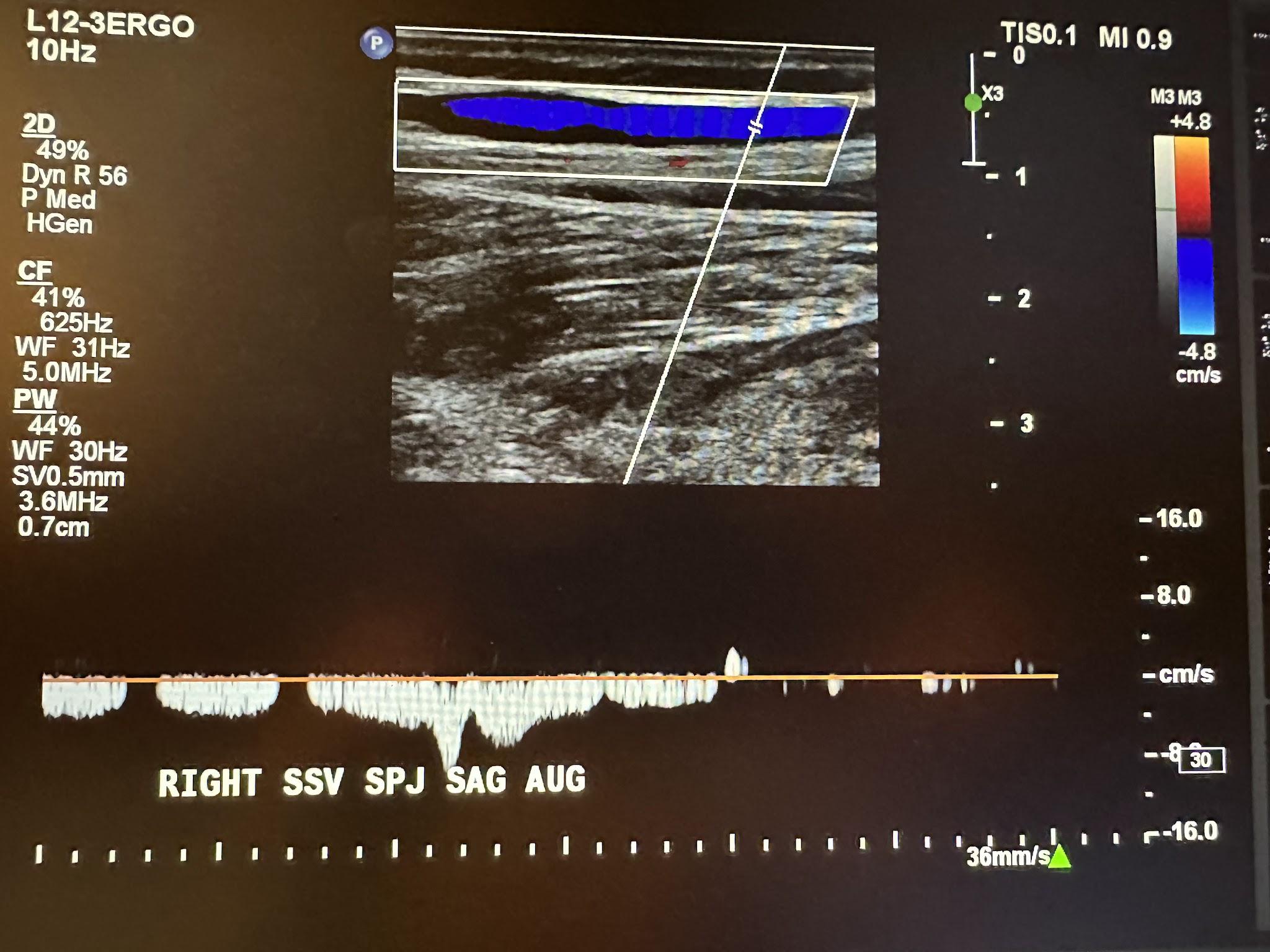 Right small saphenous vein at the saphenopopliteal junction sagittal view with augmentation.