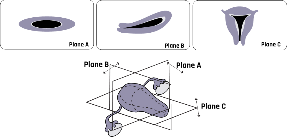 Orthogonal planes of the uterus.