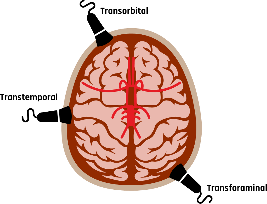 The three most common acoustic windows that provide direction to evaluate the intracranial vessels are the transtemporal, transorbital, and transforaminal windows.