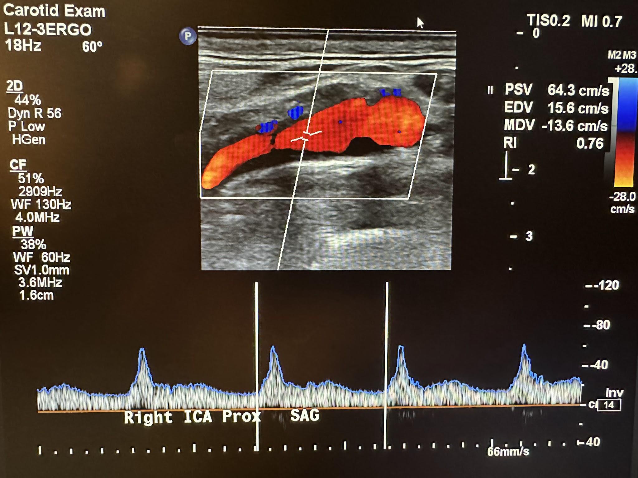 Ultrasound image showing the thermal index and mechanical index of a carotid exam in the top right corner.