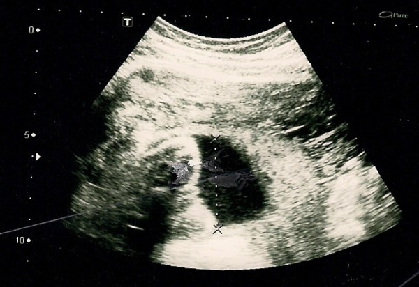 Ultrasound image at 23 weeks showing fetus, amniotic fluid, and normal fetal morphology.