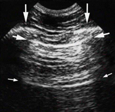 Ultrasound image of the intercostal space with the ribs shown by the vertical arrows. Rib shadows are displayed below. The upper horizontal arrows represent the pleural line, and the lower horizontal arrows represent the artifact of the pleural line, called the A-line.