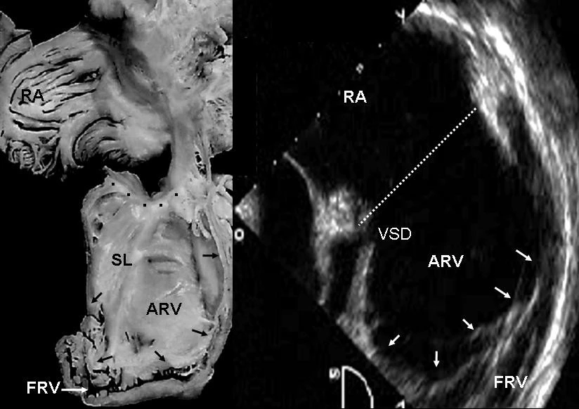 The figure on the left shows the internal view of the cardiac right chambers, and the one on the right is the echocardiographic image showing the ventricular septal defect.