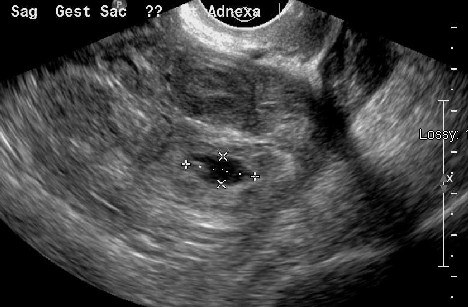 An ectopic pregnancy adjacent to the left ovary.