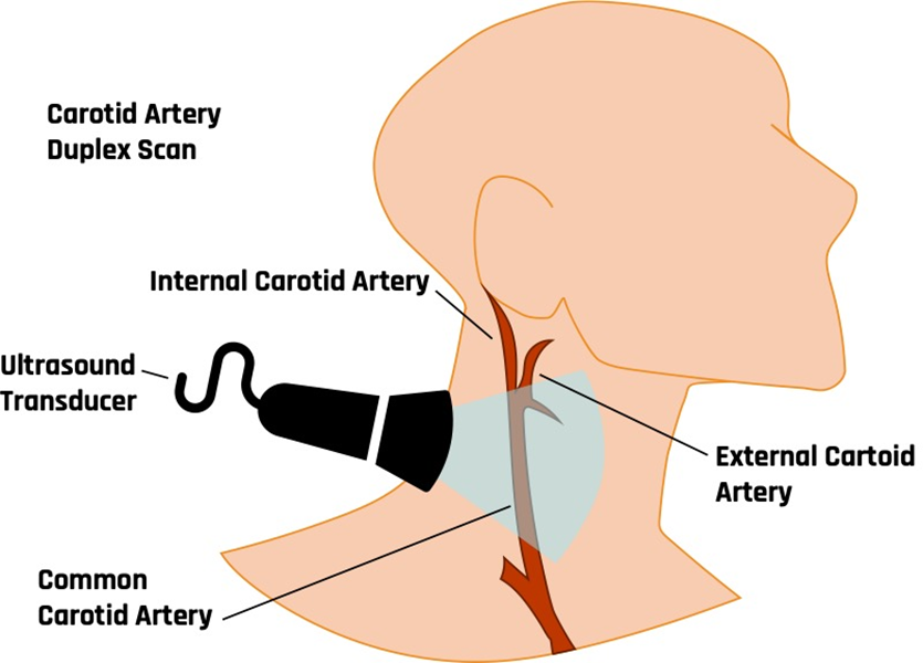 Carotid Doppler probe.