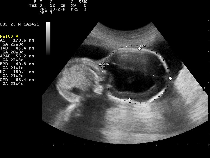 Ultrasound image of fetal hydrocephalus.